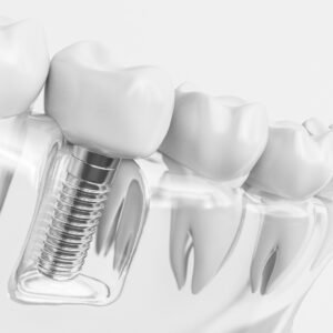 Implants Dentistry